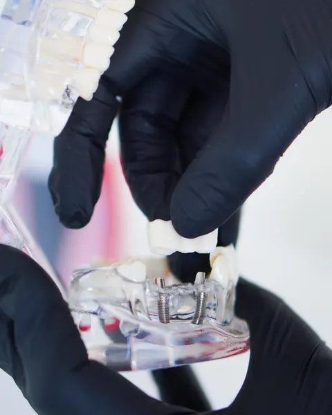 Puente de tres piezas por colocarse sobre dos implantes, en un modelo transparente
