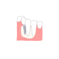 Ilustración de Implantes Dentales