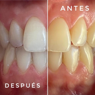 Tipos de Blanqueamiento Dental: Variedades y Aclaraciones
